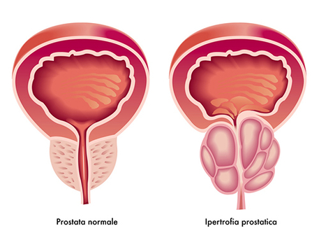 Graphikbild einer normalen Prostata neben einer vergrößerten Prostata.
